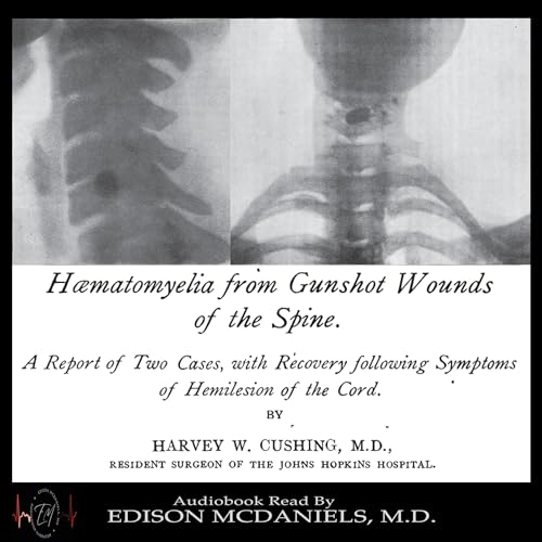 Haematomyelia from Gunshot Wounds of the Spine
